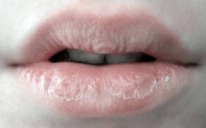 chapped lips