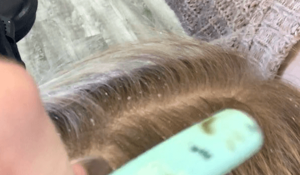 dry brushing scalp 